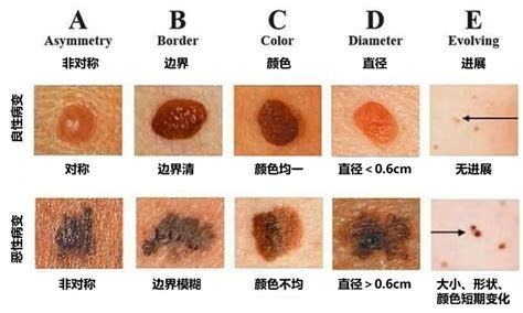 痣 斑|身上长了黑痣就是黑色素瘤吗？该怎样判断？